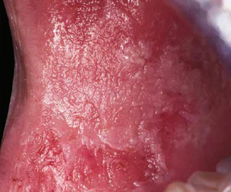 Morsicatio Buccarum (morsicatio buccarum et labiorum, cheek biting