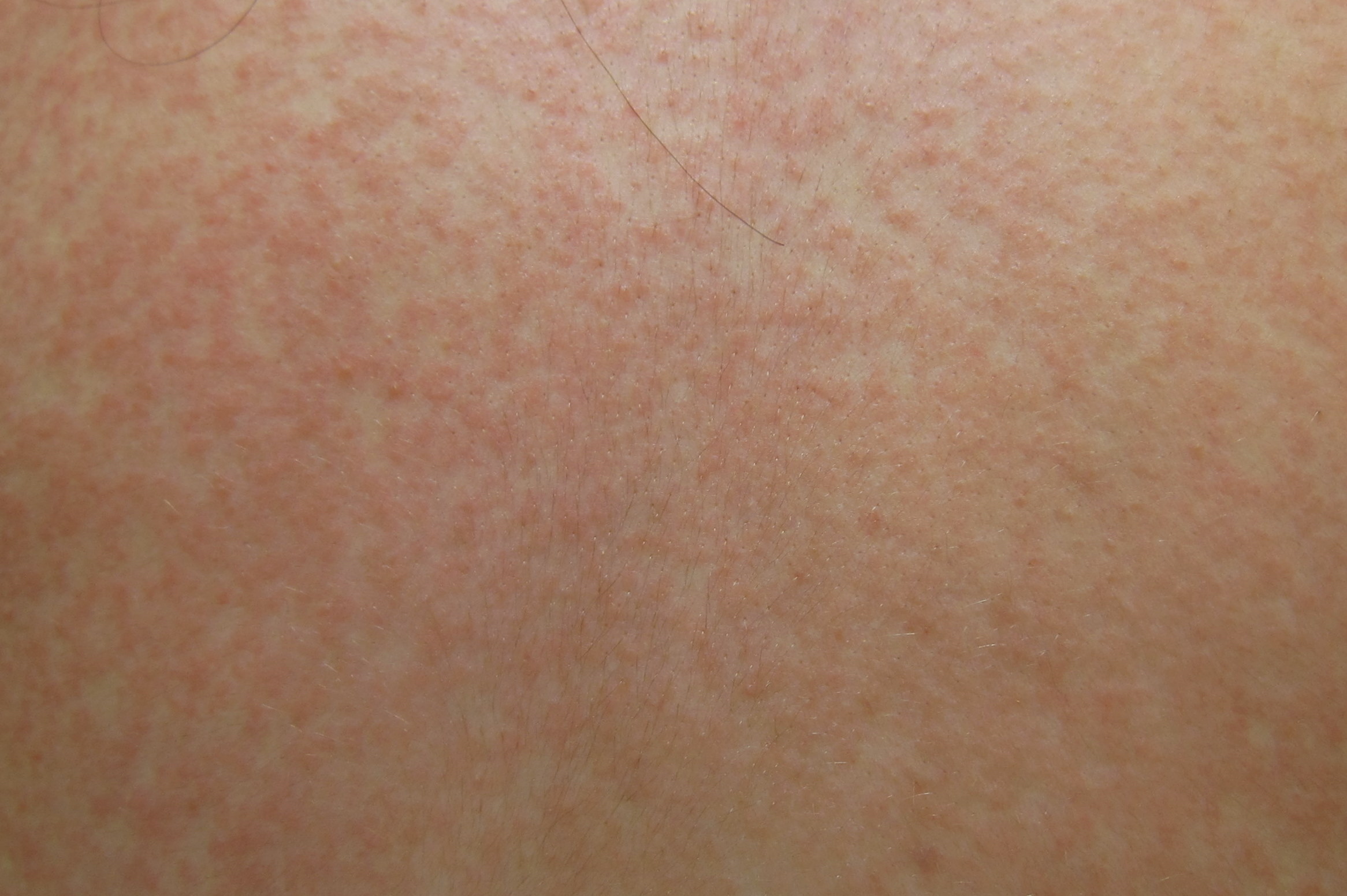 Fine Maculopapular Rash On Trunk