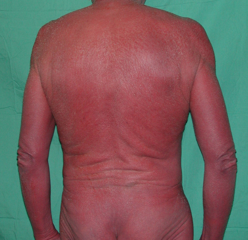 Erythroderma (Exfoliative dermatitis)