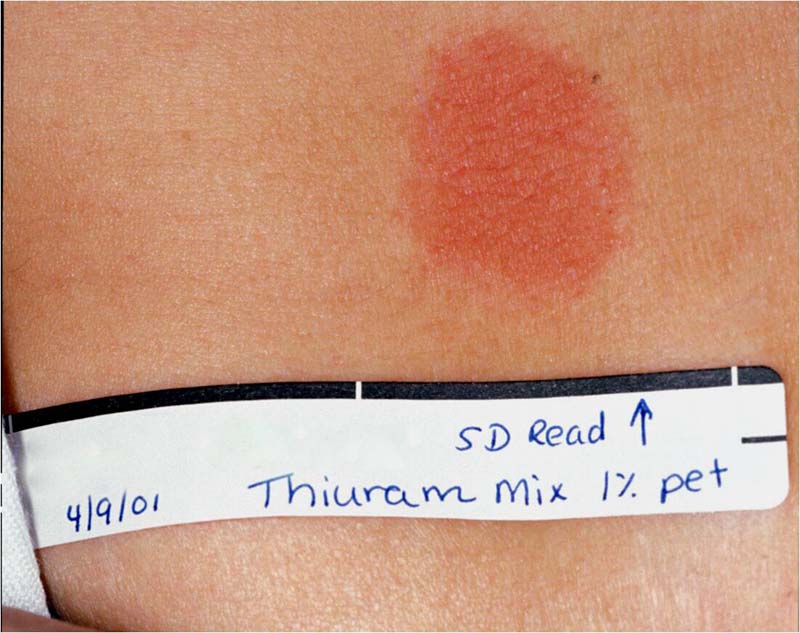 Elidel eczema clinical trials