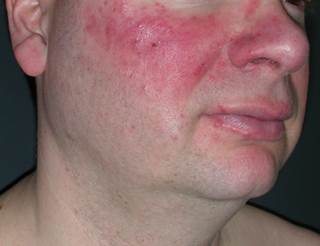 More than 8% of participants reported treatment-emergent adverse events, including application site dermatitis, paresthesia, pain, and pruritus. More than 8% of participants reported treatment-emergent adverse events, including application site dermatitis, paresthesia, pain, and pruritus.