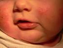 Early-Onset Eczema May Increase Risk for Childhood Asthma Early-Onset Eczema May Increase Risk for Childhood Asthma