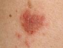 Investigational Cream Promising for Atopic Dermatitis Investigational Cream Promising for Atopic Dermatitis