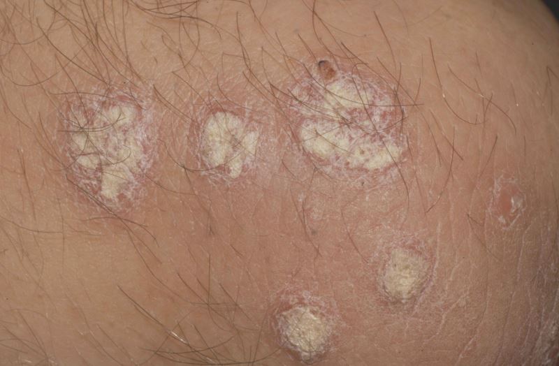 treatment skin acne Reduce Risk Biologic Psoriasis May for Therapies for