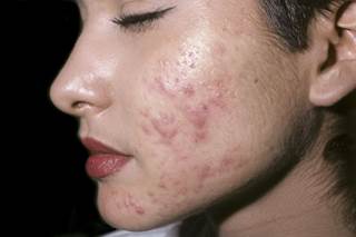 Sarecycline 1.5 mg/kg once daily significantly improved acne severity and significantly reduced inflammatory lesion count. Sarecycline 1.5 mg/kg once daily significantly improved acne severity and significantly reduced inflammatory lesion count.