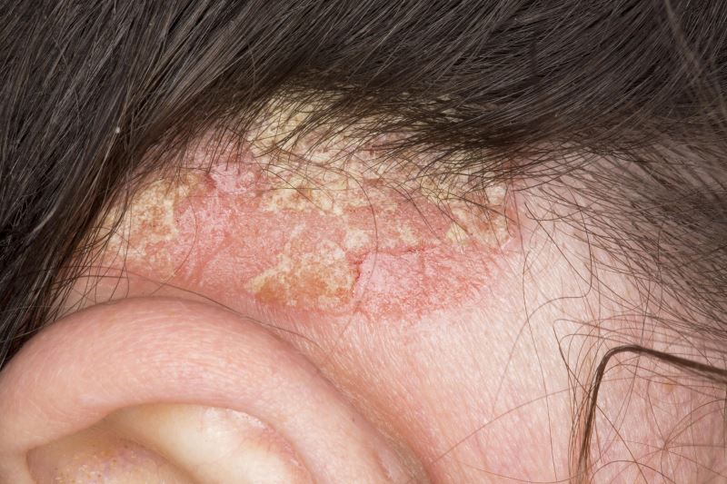 Effective Relief Of Scalp Psoriasis May Be In Sight