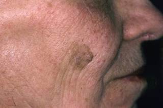 Eskata is a high-concentration hydrogen peroxide-based topical solution intended for in-office application. Eskata is a high-concentration hydrogen peroxide-based topical solution intended for in-office application.