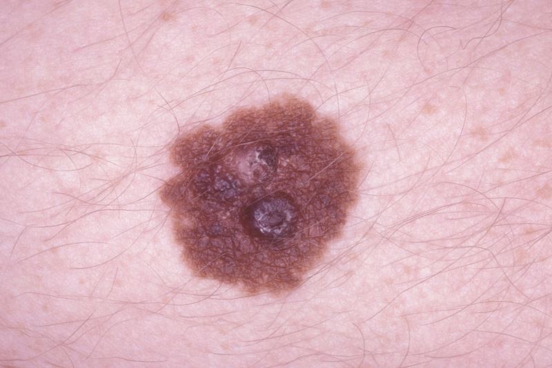 Reduced Risk of Recurrent Melanoma with Propranolol Use