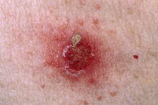 Topical application twice daily of ozenoxacin 1% cream may decrease the spread of infection in children as young as 2 months of age. Topical application twice daily of ozenoxacin 1% cream may decrease the spread of infection in children as young as 2 months of age.