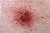 Topical Antibacterial Agent Effective for Treatment of Impetigo Topical Antibacterial Agent Effective for Treatment of Impetigo