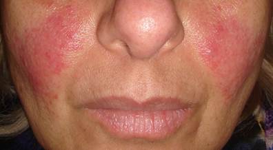 Newly Designed Pulsed-Dye Laser Found Effective for Rosacea Newly Designed Pulsed-Dye Laser Found Effective for Rosacea