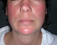 Skin Manifestations Of Thyroid Disorders A Review