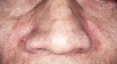 Actinic Keratosis, Seborrheic Dermatitis Common in Older Adults With HIV Actinic Keratosis, Seborrheic Dermatitis Common in Older Adults With HIV