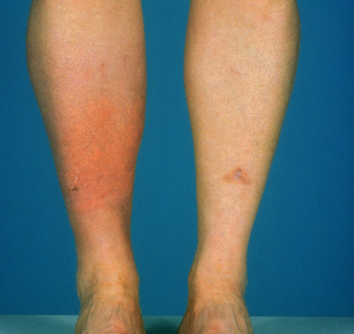 how fast does bactrim work for cellulitis