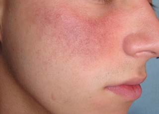 Diluted botulinum has been shown to alleviate symptoms of rosacea. Diluted botulinum has been shown to alleviate symptoms of rosacea.