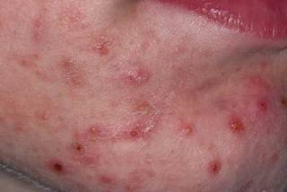 Acne lesion morphology was not associated with the severity of an individual's acne. Acne lesion morphology was not associated with the severity of an individual's acne.