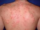 Dapsone Efficacy Examined in Patients With Chronic Spontaneous Urticaria Dapsone Efficacy Examined in Patients With Chronic Spontaneous Urticaria