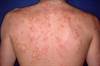 Dapsone Efficacy Examined in Patients With Chronic Spontaneous Urticaria Dapsone Efficacy Examined in Patients With Chronic Spontaneous Urticaria