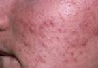 Strategies for Preventing Antibiotic Resistance in Acne Strategies for Preventing Antibiotic Resistance in Acne