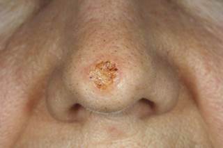 Researchers found that higher use of hydrochlorothiazide (≥50,000 mg) was associated with odds ratios of 1.29 and 3.98 for basal cell and squamous cell carcinoma, respectively. Researchers found that higher use of hydrochlorothiazide (≥50,000 mg) was associated with odds ratios of 1.29 and 3.98 for basal cell and squamous cell carcinoma, respectively.