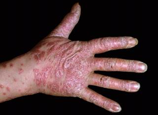 The investigators sought to evaluate the long-term, 52-week efficacy and safety of apremilast monotherapy compared with apremilast combination therapy in patients with psoriasis. The investigators sought to evaluate the long-term, 52-week efficacy and safety of apremilast monotherapy compared with apremilast combination therapy in patients with psoriasis.