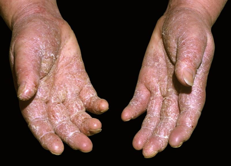 Treatment for plaque psoriasis 