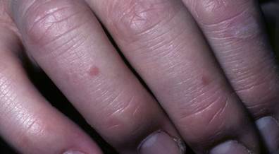 Squaric Acid Dibutylester Superior Treatment for Cutaneous Warts Squaric Acid Dibutylester Superior Treatment for Cutaneous Warts