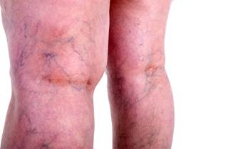 New risk factors have been identified for varicose vein disease, including height. New risk factors have been identified for varicose vein disease, including height.