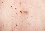 Skin Cancer After Organ Transplant Declining Skin Cancer After Organ Transplant Declining