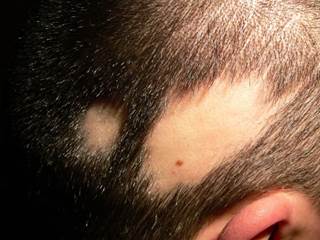 Patients with androgenetic alopecia showed significant clinical and dermoscopic improvement after carboxytherapy. Patients with androgenetic alopecia showed significant clinical and dermoscopic improvement after carboxytherapy.