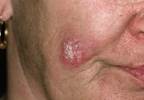 Depression Risk High in Cutaneous, Systemic Lupus Erythematosus Depression Risk High in Cutaneous, Systemic Lupus Erythematosus