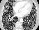 Nintedanib and Pirfenidone Tolerated in Idiopathic Pulmonary Fibrosis Nintedanib and Pirfenidone Tolerated in Idiopathic Pulmonary Fibrosis