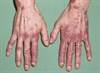 EULAR/ACR Systemic Lupus Erythematosus Classification Criteria Update EULAR/ACR Systemic Lupus Erythematosus Classification Criteria Update