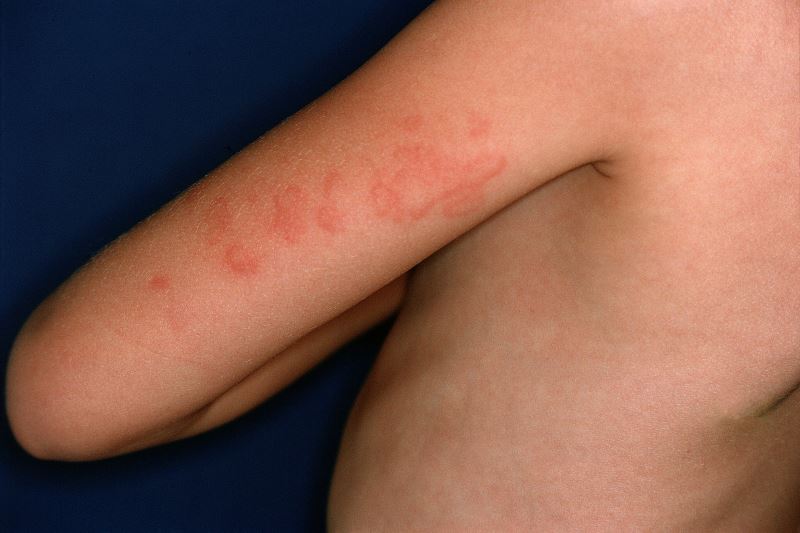 chronic-spontaneous-urticaria-disease-activity-treatment-response