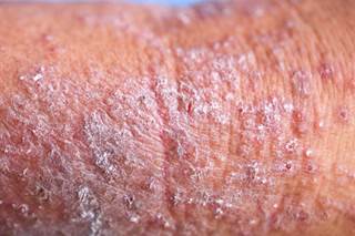 The researchers found that the 830 patients with moderate/severe AD reported more severe itching and pain, greater adverse effects on sleep, higher prevalence of anxiety and depression. The researchers found that the 830 patients with moderate/severe AD reported more severe itching and pain, greater adverse effects on sleep, higher prevalence of anxiety and depression.