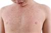 Dapsone Efficacy Examined in Patients With Chronic Spontaneous Urticaria Dapsone Efficacy Examined in Patients With Chronic Spontaneous Urticaria