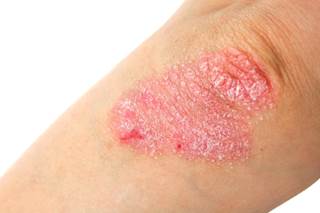 Investigators sought to understand how biologic and systemic therapies affect risk for herpes zoster infection in patients with psoriasis. Investigators sought to understand how biologic and systemic therapies affect risk for herpes zoster infection in patients with psoriasis.
