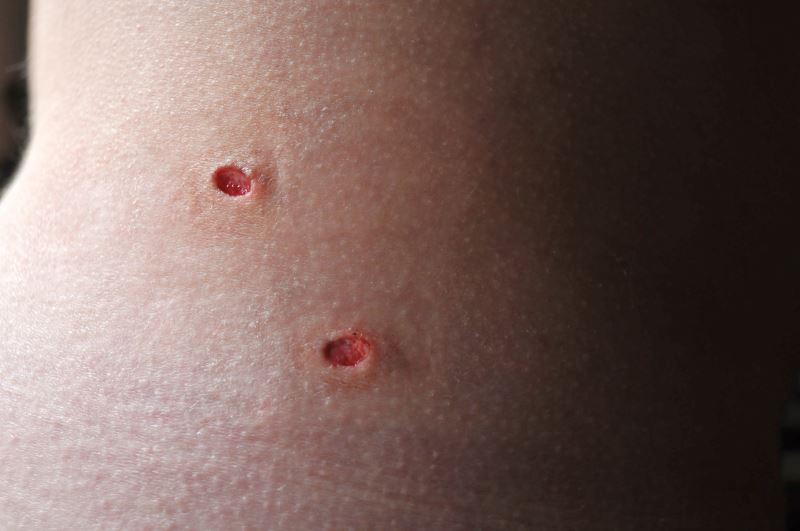 Nearly 25% of Skin Biopsies Diagnosed as Melanocytic 
