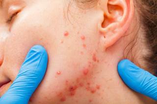The presence of acne was not associated with the development of subsequent MM in individuals examined in this study. The presence of acne was not associated with the development of subsequent MM in individuals examined in this study.