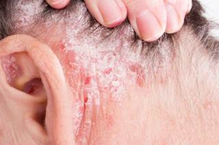 Screening is advised for all patients with psoriasis contemplating treatment with an immunosuppressive agent and monitoring of HBV viral load in patients who are anti-hepatitis B core antibody-positiv Screening is advised for all patients with psoriasis contemplating treatment with an immunosuppressive agent and monitoring of HBV viral load in patients who are anti-hepatitis B core antibody-positiv