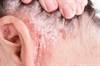 Biologic Psoriasis Therapies Pose Limited Risk for Hepatitis B Reactivation Biologic Psoriasis Therapies Pose Limited Risk for Hepatitis B Reactivation