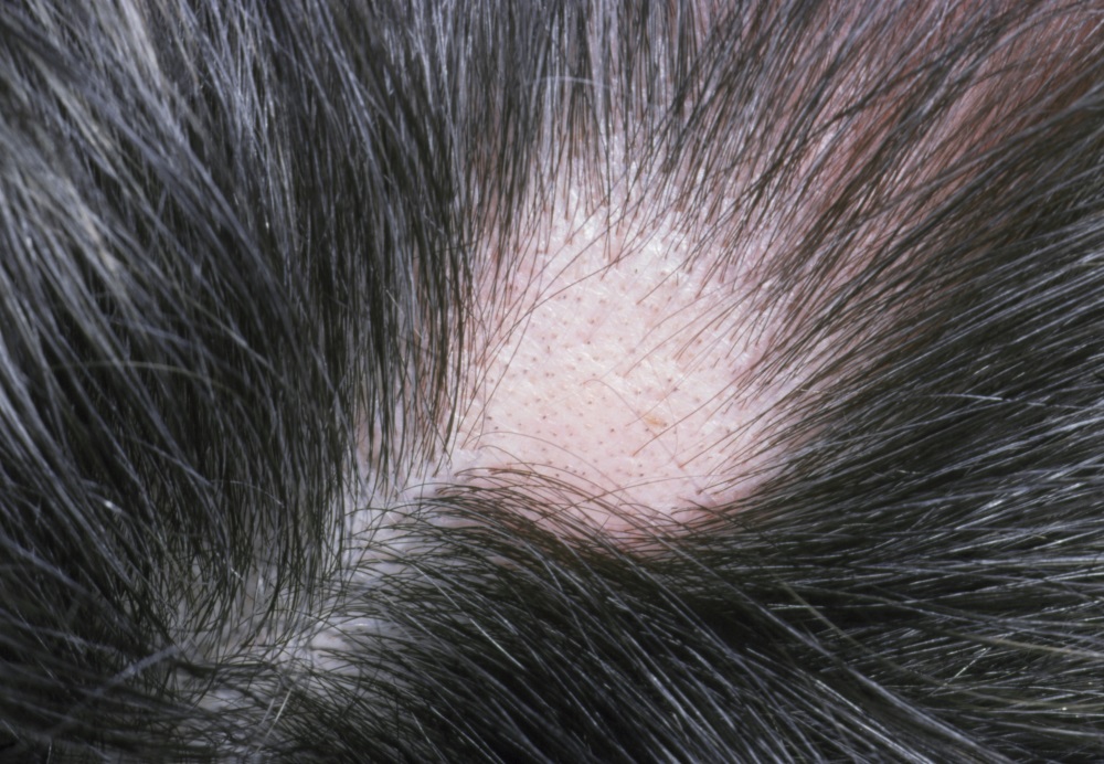 Alopecia - androgenetic