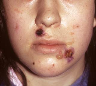 Phase 3 study results demonstrated the treatment substantially improved pemphigus vulgaris remission rates. Phase 3 study results demonstrated the treatment substantially improved pemphigus vulgaris remission rates.