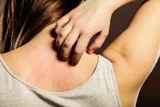 Products containing synthetic fragrances, sulfates, and preservatives can exacerbate skin inflammation in patients. Products containing synthetic fragrances, sulfates, and preservatives can exacerbate skin inflammation in patients.