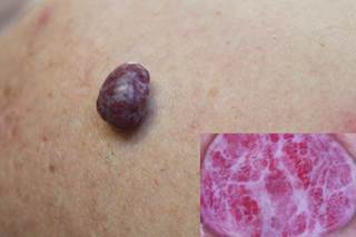 Infantile hemangiomas located on the lips or of a superficial form were factors most likely to contribute to delayed referral. Infantile hemangiomas located on the lips or of a superficial form were factors most likely to contribute to delayed referral.
