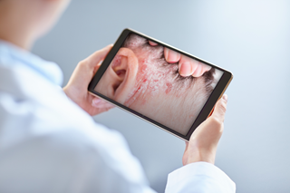 Biologic agents reduced the risk for depressive symptoms significantly compared to phototherapy in psoriasis. Biologic agents reduced the risk for depressive symptoms significantly compared to phototherapy in psoriasis.