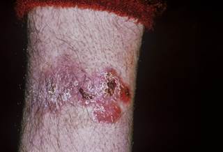 Changes in the absolute number of blisters were significant in the diacerein group only. Changes in the absolute number of blisters were significant in the diacerein group only.