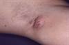 Treatment of Hidradenitis Suppurativa With SAPHO Syndrome: A Case Review Treatment of Hidradenitis Suppurativa With SAPHO Syndrome: A Case Review