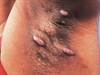 Adalimumab Reduces Skin Pain in Hidradenitis Suppurativa Adalimumab Reduces Skin Pain in Hidradenitis Suppurativa