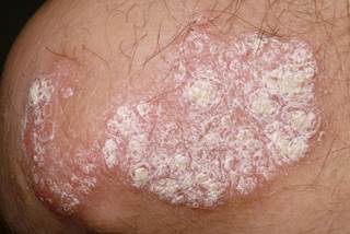 Investigators evaluated the effect of ixekizumab withdrawal and retreatment in Japanese patients with plaque psoriasis in this single-arm open-label phase 3 study.